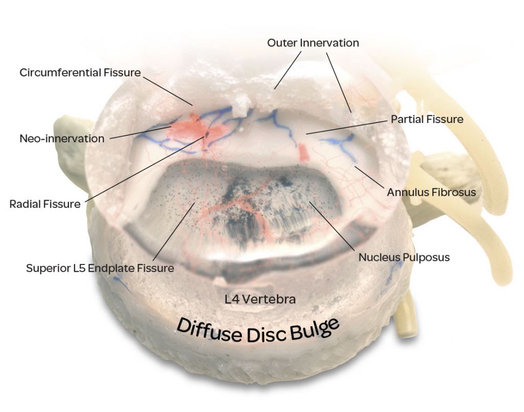 Professional LxH Dynamic Disc Model