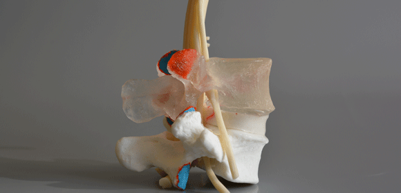 Lumbar Models - Dynamic Disc Designs