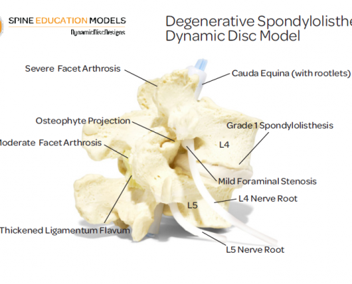 degenerative spondylolisthesis