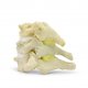 Cervical Spinal Stenosis Dynamic Disc Model 1 2