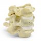 Cervical Spinal Stenosis Dynamic Disc Model 2 2