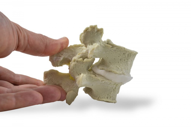 Degenerative Spondylolisthesis Model 4