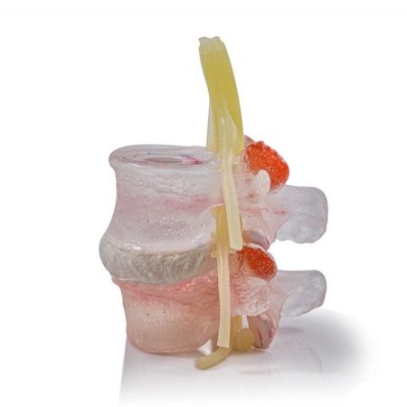 Fully Clear Herniated Disc Model 1