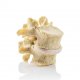 Lumbar Spinal Stenosis Model 1