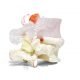 Spondylolytic Spondylolisthesis Dynamic Disc Model 2 1