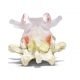 Spondylolytic Spondylolisthesis Dynamic Disc Model 3 1