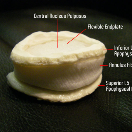 lumbar endplate modeling