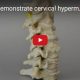 Hypermobilty Cervical Model Youtube