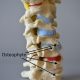 Cervical spinal models degenerated