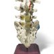 Double Spondylolisthesis Lumbar Dynamic Disc Model 1