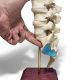 Double Spondylolisthesis Lumbar Dynamic Disc Model 2