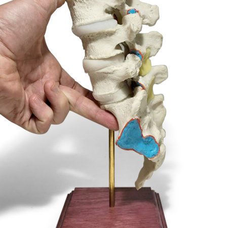 Double Spondylolisthesis Lumbar Dynamic Disc Model 3