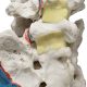 Double Spondylolisthesis Lumbar Dynamic Disc Model 5