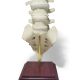 Double Spondylolisthesis Lumbar Dynamic Disc Model 8