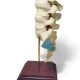 Double Spondylolisthesis Lumbar Dynamic Disc Model 9