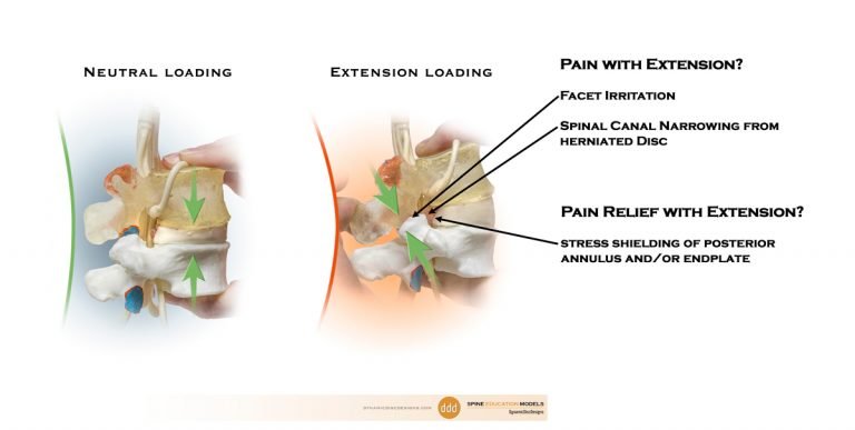 Neutral vs Extension loading Pain Generators and Relievers