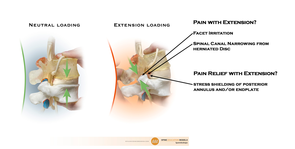 Neutral vs Extension loading Pain Generators and Relievers