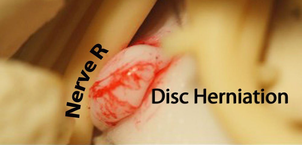 Disc Herniation Model