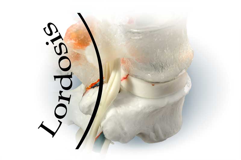 Lordosis