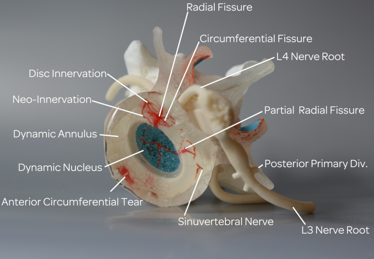 Non specific Back Pain