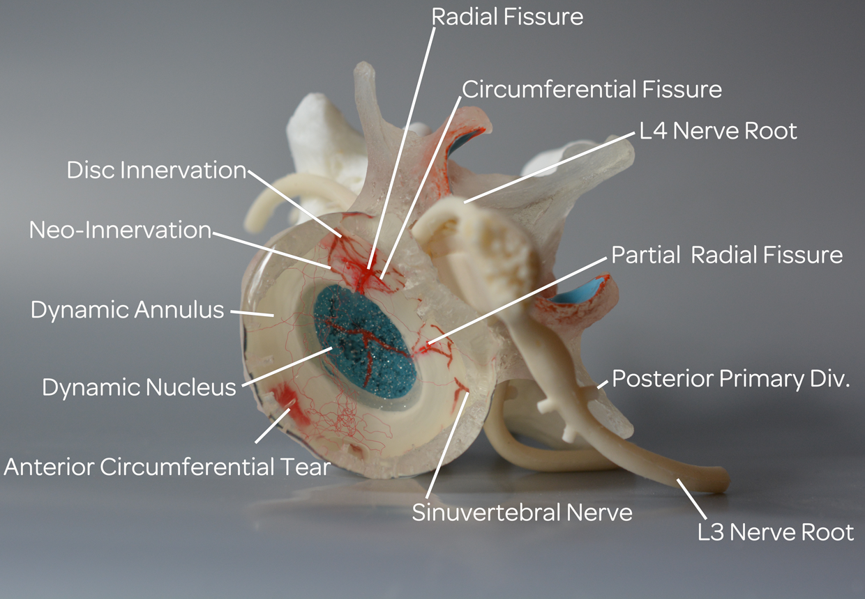 Non specific Back Pain