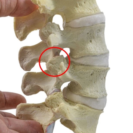 Hypermobility Lumbar Model L2 L5 7