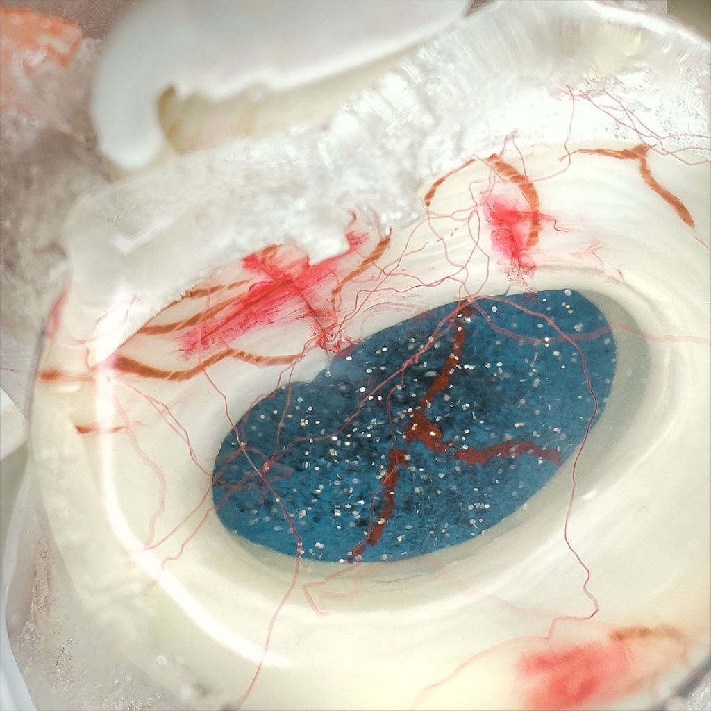 fissures in the annulus fibrosis