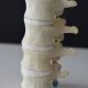 L1 4 Hypermobile Lumbar Model Anterolateral