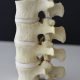 L1 4 Hypermobile Lumbar Model Lateral