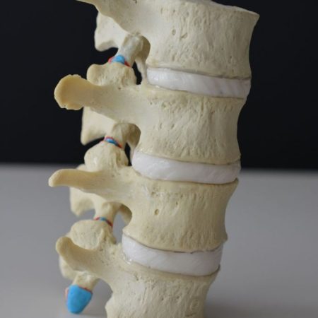 L1 4 Hypermobile Lumbar Model Lateral Anterior