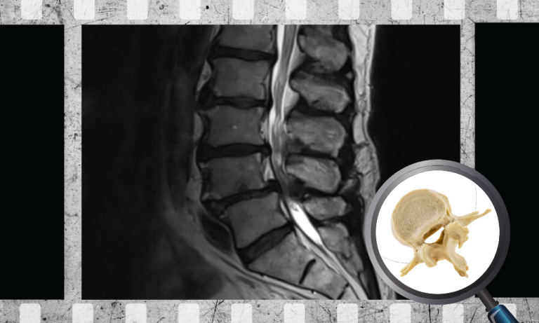 Whats the Relationship Between MRI Findings Clinical Symptoms in Patients with Suspected Lumbar Spinal Canal Stenosis
