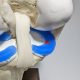 Dynamic Knee Model with Blue Menisci and radial tear scaled