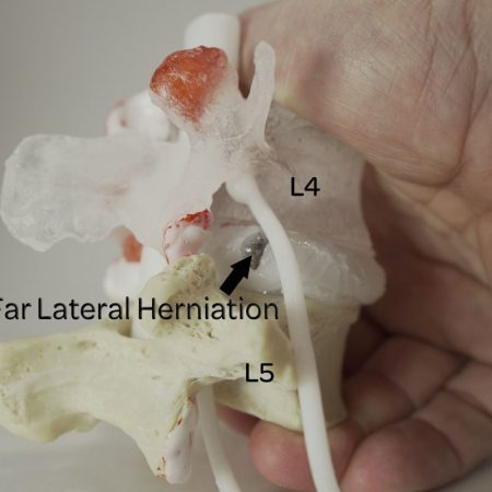 Far Lateral Disc Herniation Labelled