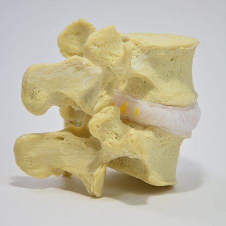 Multi location disc herniation model 3