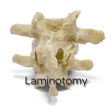 Laminotomy Model Dynamic Disc Designs 3