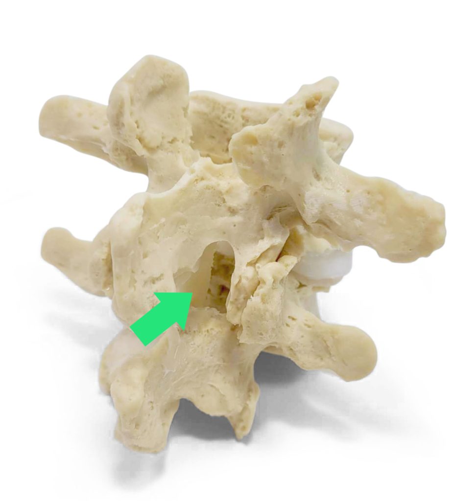 Laminotomy Model Dynamic Disc Designs