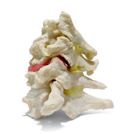 Cervical Instability Model 2 1