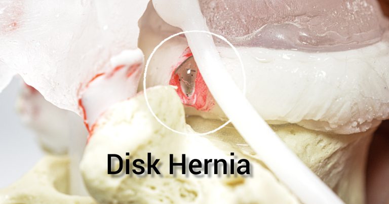 Disc herniation model