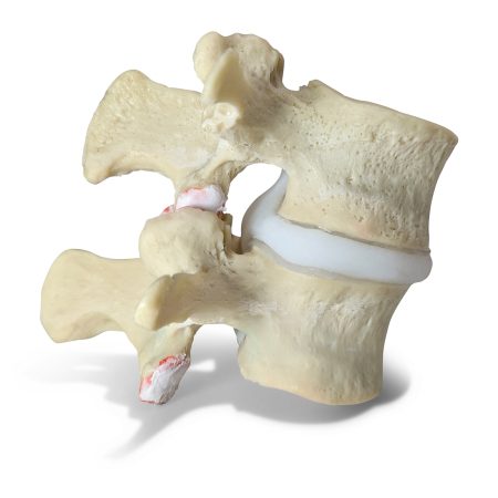 Spondylolisthesis L2 3 Grade 1 anterolisthesis 4