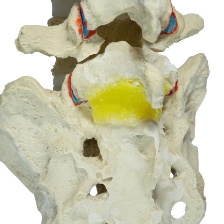 L4 Sacrum Spondylolysis Pars interacrticularis defect model (2)