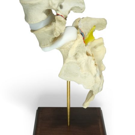 L4 Sacrum Spondylolytic Grade 2 Spondylolisthesis Model 1 scaled